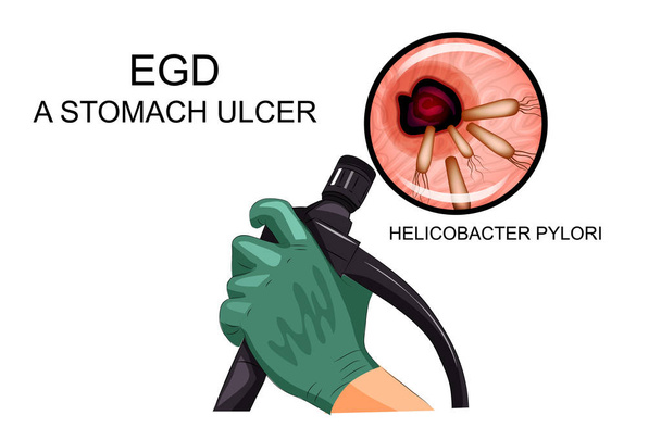 EGD, diagnose van maagzweer - Vector, afbeelding