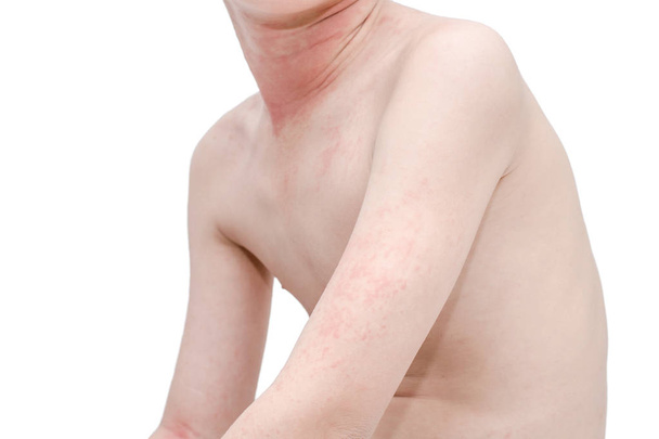 Pelle con rash cutaneo
  - Foto, immagini