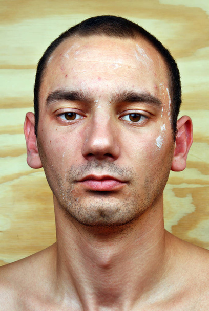 Az ember a fertőzött bőr az arcon - Fotó, kép