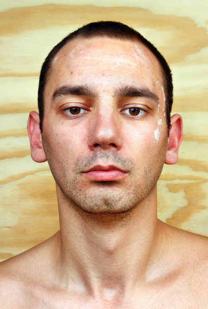 Hombre joven con cándida albicans crónica infectada
 - Foto, Imagen