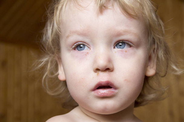 Małe dziecko przystojny chory zapalenie spojówek - Zdjęcie, obraz
