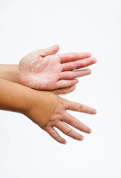 Kuivat kädet, kuorinta, kosketusihottuma, sieni-infektiot
 - Valokuva, kuva