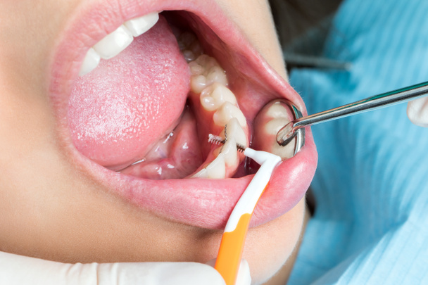 Limpieza interdental en dientes humanos
 - Foto, Imagen