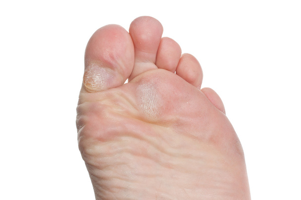 Келлус на пальцях ноги
 - Фото, зображення