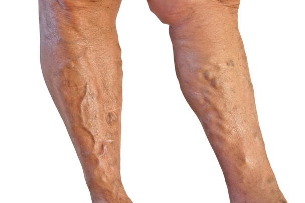 Varicose veins - Photo, Image
