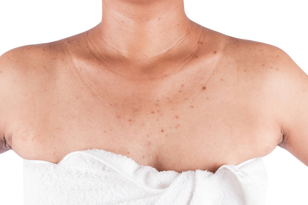 acne op lichaam huid op witte achtergrond - Foto, afbeelding
