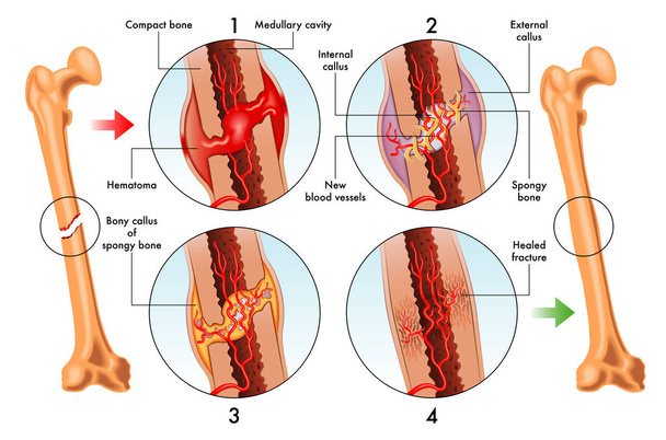 Ilustración médica de las etapas de reparación de fracturas óseas
 - Vector, imagen