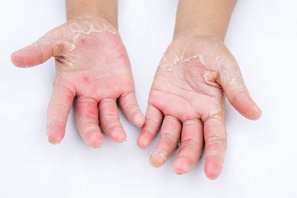 mãos secas, casca, dermatite de contato, infecções fúngicas, pele inf
 - Foto, Imagem