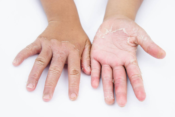 Trockene Hände, Peeling, Kontaktdermatitis, Pilzinfektionen, Hautinfektionen durch Exposition - Foto, Bild