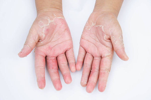 Ξηρά χέρια, φλούδα, δερματίτιδα εξ επαφής, μυκητιάσεις δέρματος inf - Φωτογραφία, εικόνα