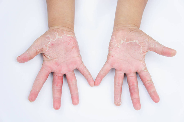Kuivat kädet, kuorinta, kosketusihottuma, sieni-infektiot, ihon
 - Valokuva, kuva