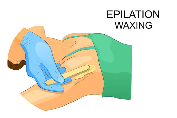 waxing of hair in the armpits - Vector, Image