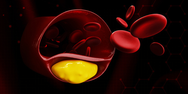 血管の病気のコレステロール シンボルの歯垢の蓄積と血液細胞とひと心臓血管系の 3 d イラストレーション. - 写真・画像