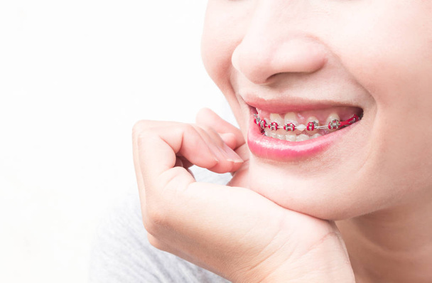 Close up woman smiling with Ceramic and Metal Braces on white background, beauty and healthy concept - Foto, Imagen