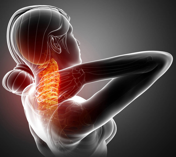 Érzés a nyaki fájdalom a nők - Fotó, kép