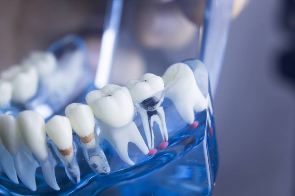 Modelo de placa de dentes dentários
 - Foto, Imagem