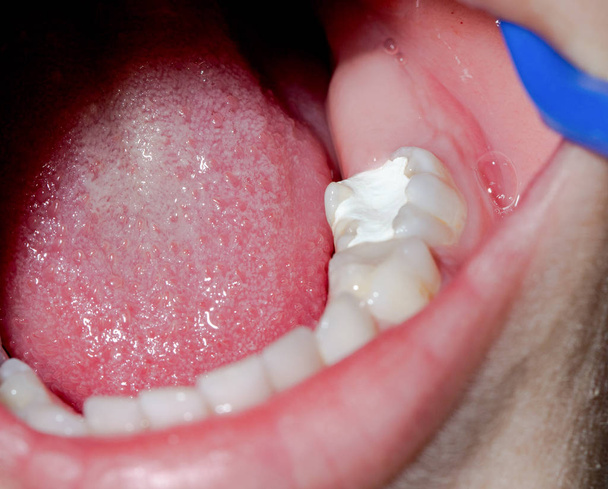 makro zubu s amalgámem plnění - Fotografie, Obrázek