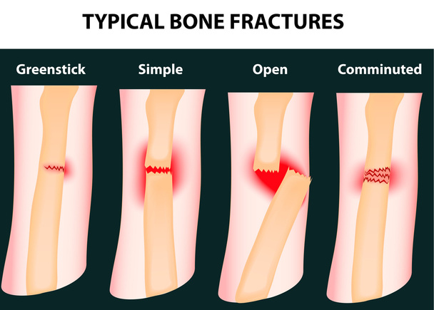 Fracturas óseas típicas
 - Vector, imagen