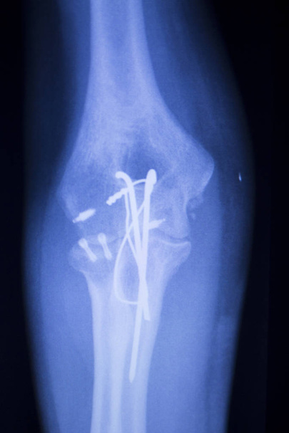 Staw łokciowy implantu xray - Zdjęcie, obraz