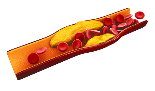 3D απεικόνιση των κυττάρων του αίματος με συσσώρευση πλάκας χοληστερόλης απομονωμένη λευκό - Φωτογραφία, εικόνα