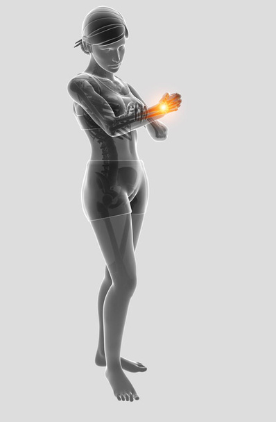 3 d イラストの女性感肘の痛み - 写真・画像