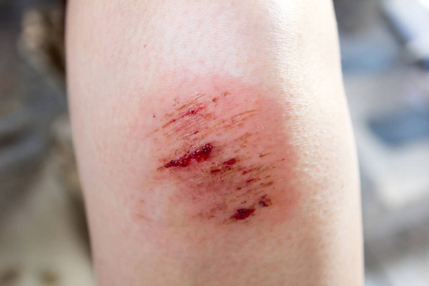 Bruised wound injury on woman knee background - Photo, Image