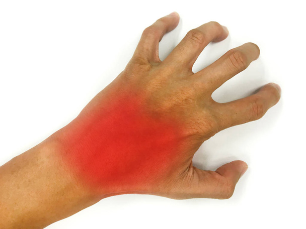  Entzündungsmuskel an der Hand, Entzündungsmuskel an der Rückhand - Foto, Bild