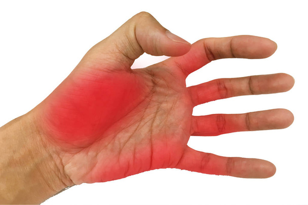  Entzündungsmuskel an der Hand, Entzündungsmuskel an der Rückhand - Foto, Bild