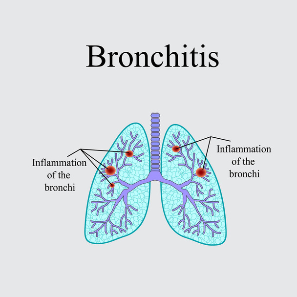 Bronquitis. La estructura anatómica del pulmón humano. Ilustración vectorial sobre fondo gris
 - Vector, imagen