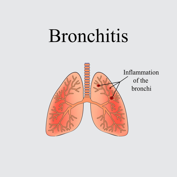 Bronquitis. La estructura anatómica del pulmón humano. Ilustración vectorial sobre fondo gris
 - Vector, imagen