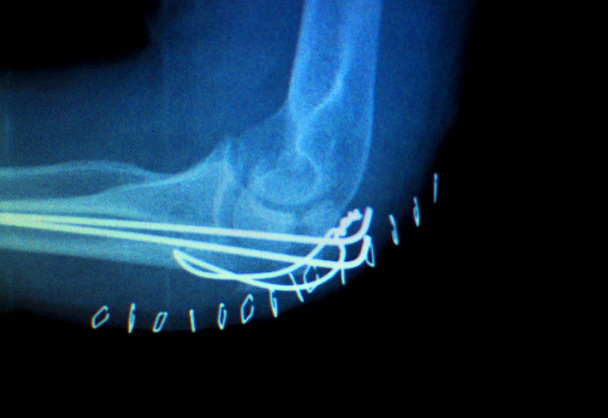 Radiografía de implante de articulación del codo
 - Foto, Imagen