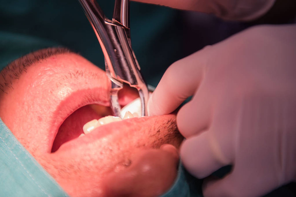 Karieszahnextraktion durch den Zahnarzt. Zahnmedizin im Krankenhaus.   - Foto, Bild