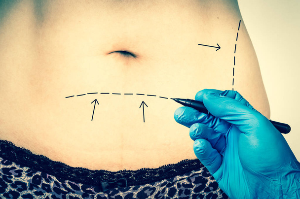 Chirurgie plastique médecin tracer des lignes sur le ventre du patient - style rétro
 - Photo, image