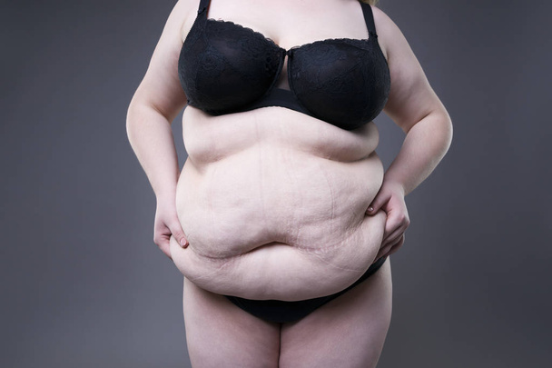 Fat female belly, overweight body, woman with stretch marks on abdomen - Fotografie, Obrázek