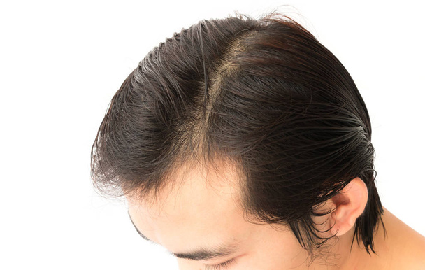 Joven hombre serio problema de pérdida de cabello para la atención médica
  - Foto, Imagen