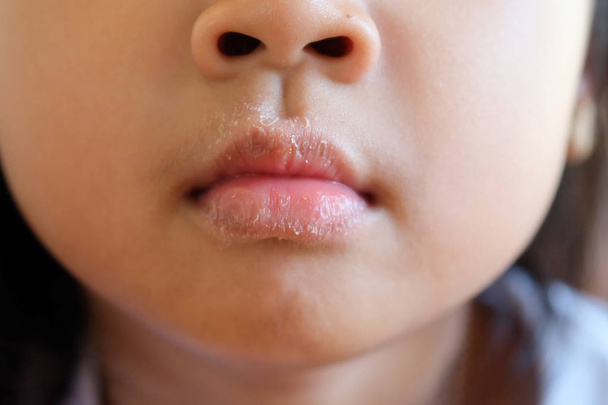 Zbliżenie: usta azjatyckich dziewczyna z alergią, skóry, łuszczenie i swędzenie. - Zdjęcie, obraz