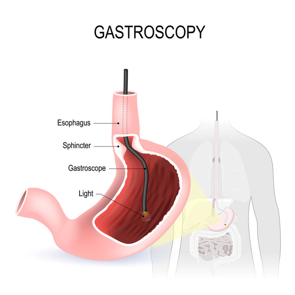 Gastroscopia, esofagoscopia e duodenoscopia
 - Vetor, Imagem