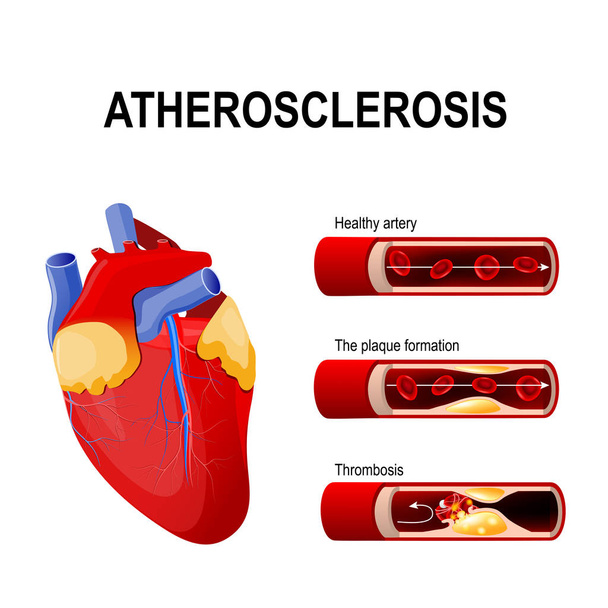Ateroskleroz aşamaları: sağlıklı arter, plak oluşumu ve tromboz. A - Vektör, Görsel