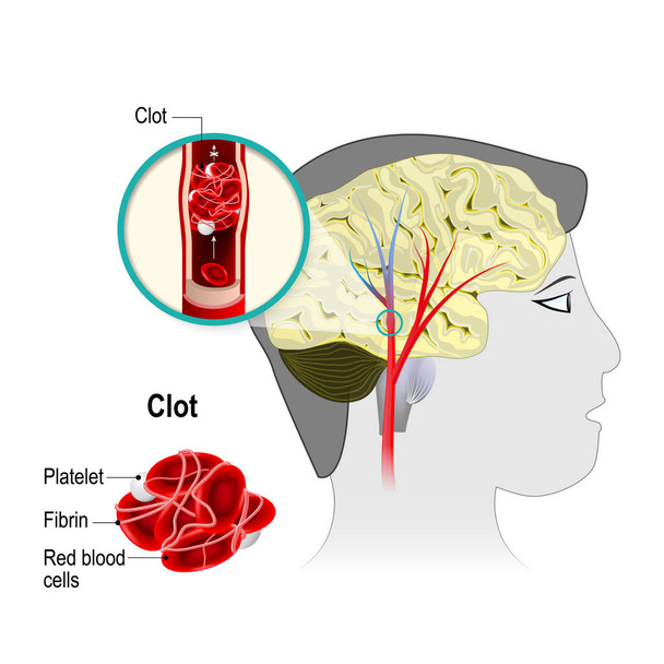 Cerebral infarction. brain stroke - Vector, Image