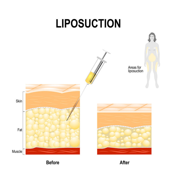 Liposuctie proces en gebieden voor lipo.  - Vector, afbeelding