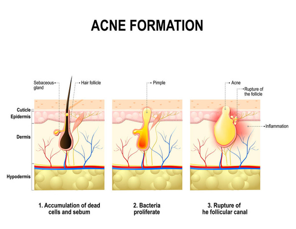 Trois étapes de la formation de l'acné dans la peau humaine
.  - Vecteur, image