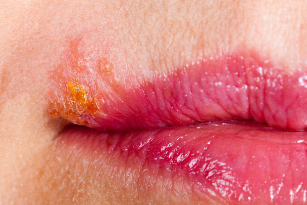Herpes en el labio de cerca macro
 - Foto, imagen