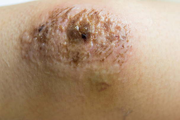 Closed up of red scab injury on woman knee background - Photo, Image