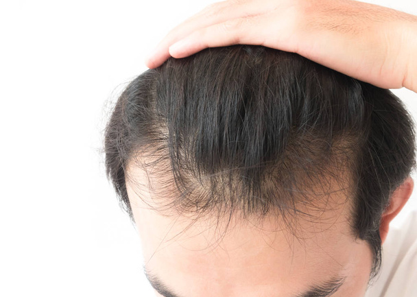 Молода людина серйозна проблема випадіння волосся для шампунь охорони здоров'я і
  - Фото, зображення
