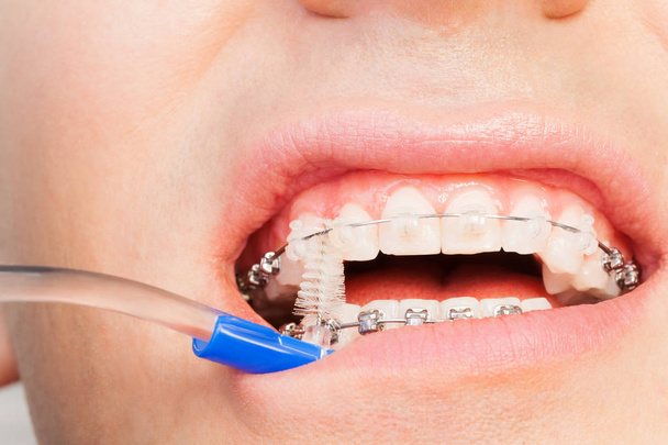 Man cleaning orthodontic braces with brush - 写真・画像