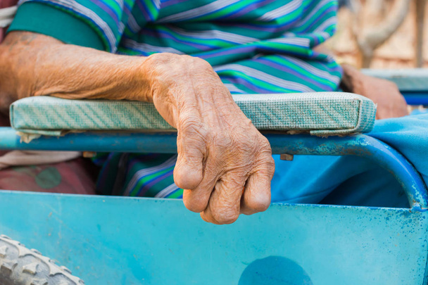 Рука старика, страдающего проказой, ампутированная рука, на инвалидном кресле
 - Фото, изображение