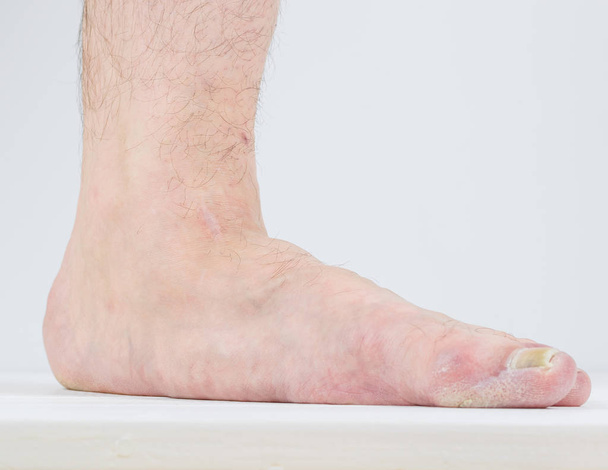 Manifestation de pieds plats et de maladies fongiques
. - Photo, image