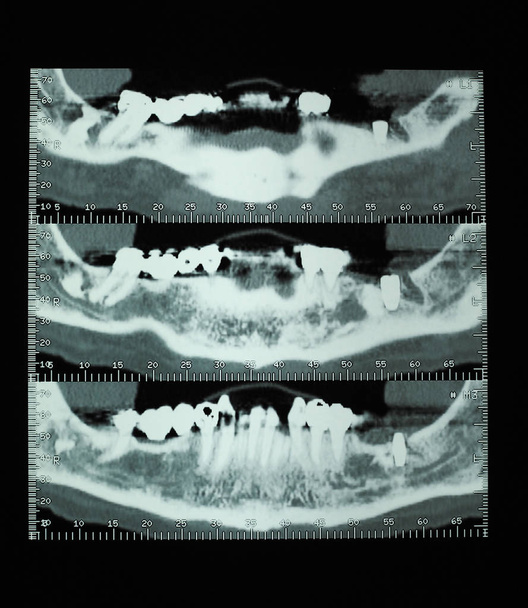 CT scan (aka CAT scan) cross sectional tomographic images x ray of human teeth bones - Photo, Image