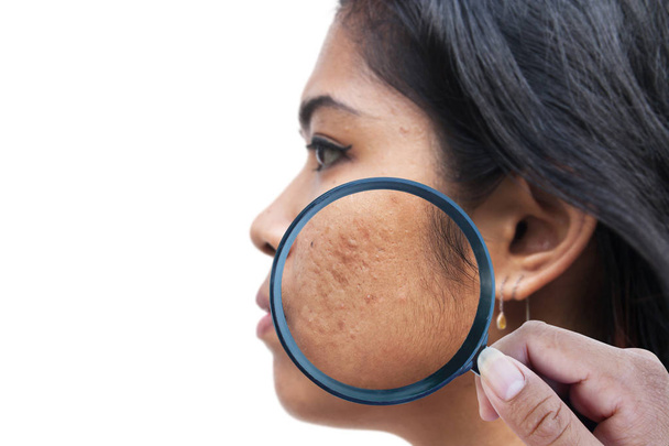 acne on skin face women - Photo, image