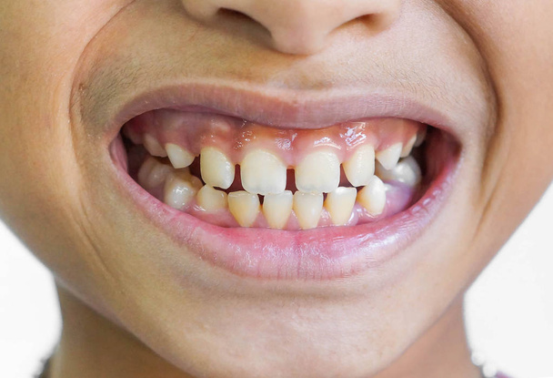 Přední zuby mezery / nadměrné mezery mezi zuby - Fotografie, Obrázek